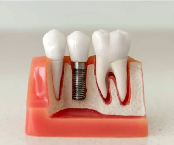 Преимущества зубного протезирования All-on-6