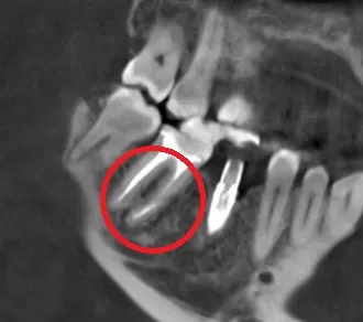 Фото после процедуры