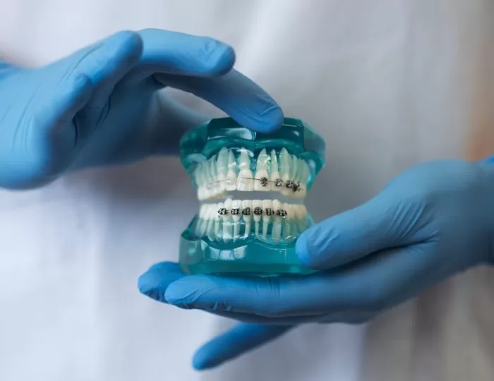 Брекет системы