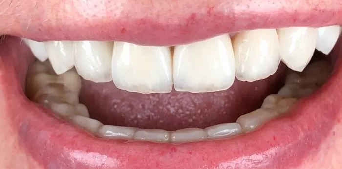 Фото после процедуры