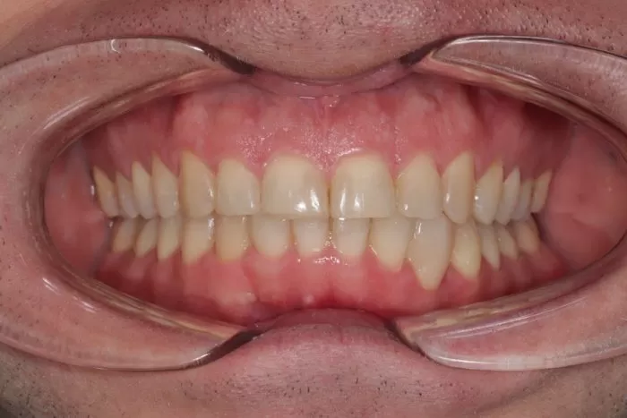 Фото после процедуры