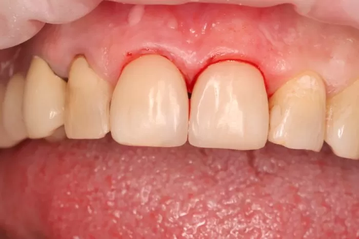 Фото после процедуры