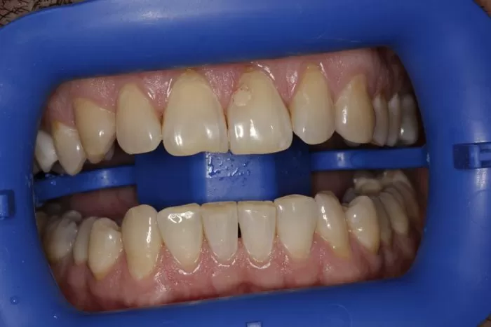 Фото до процедуры